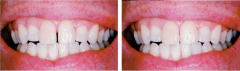 歯と歯の隙間を埋めるビフォーアフター