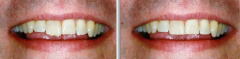 前歯の形の修復ビフォーアフター
